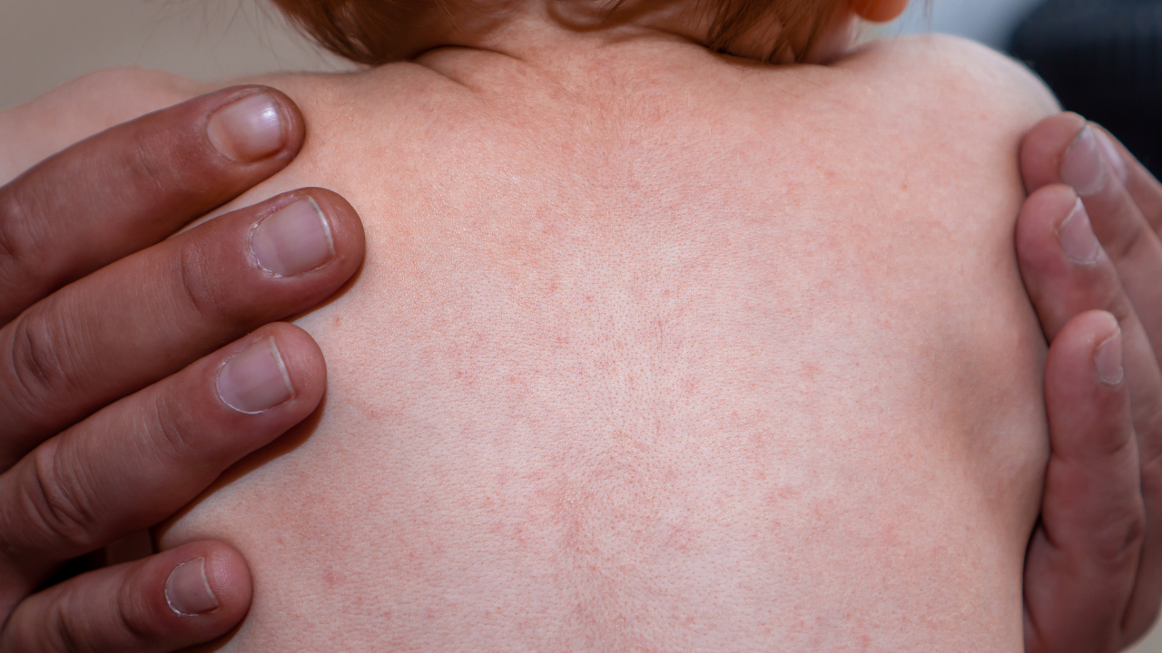 Lichtroze uitslag op de romp van een baby bij de zesde ziekte (exanthema subitum)