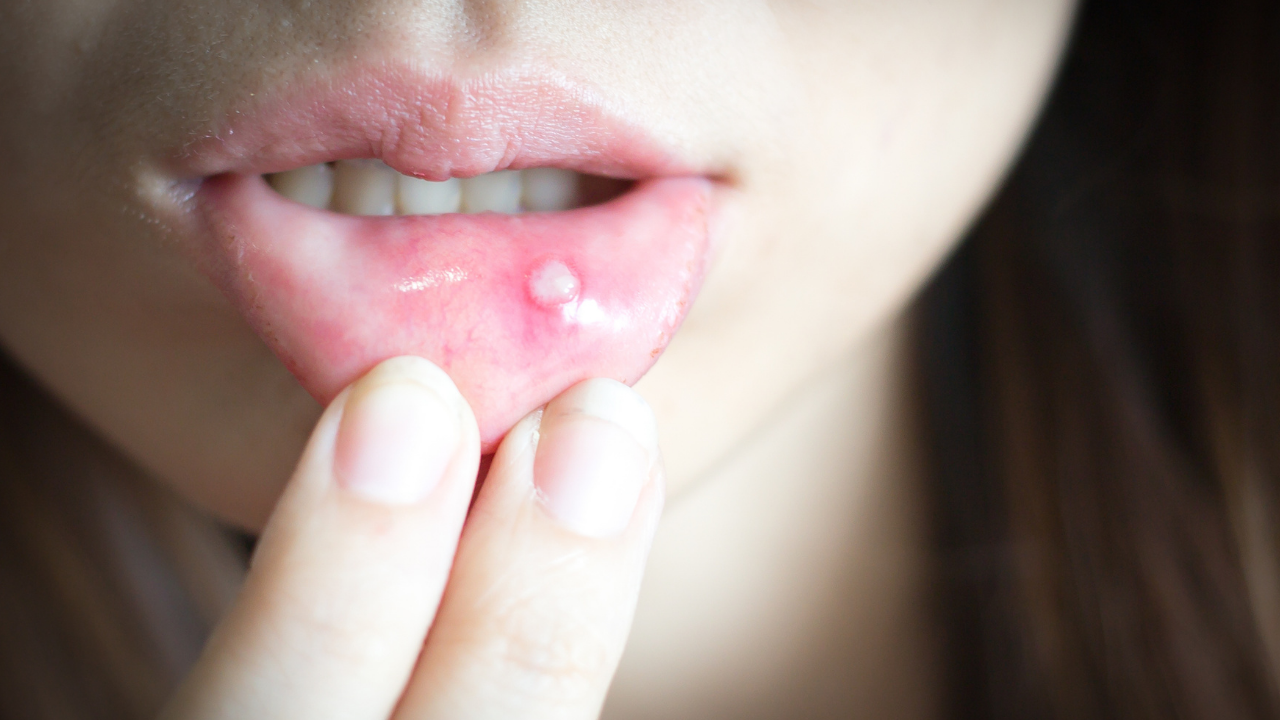 Kleine witte aft op het mondslijmvlies: typisch beeld van aphthous stomatitis