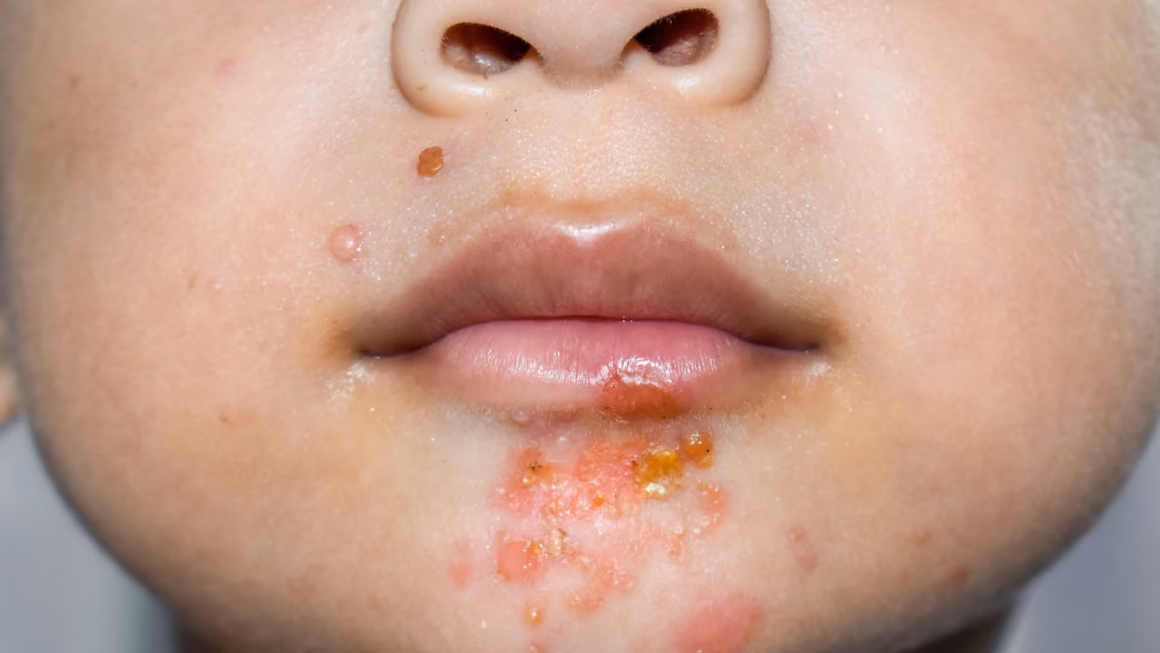 Gele honingkleurige korsten rond de mond bij een kind, krentenbaard (impetigo)