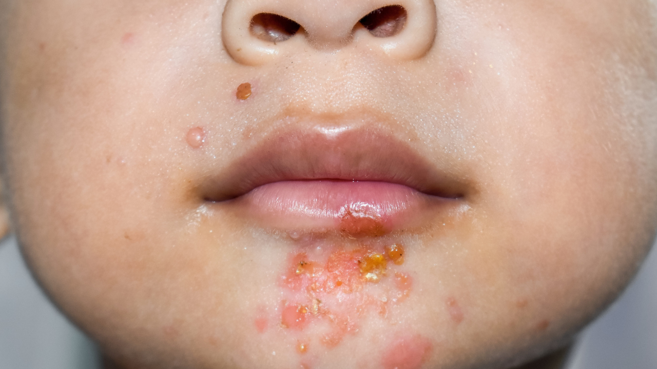Gele honingkleurige korsten rond de mond bij een kind, krentenbaard (impetigo)