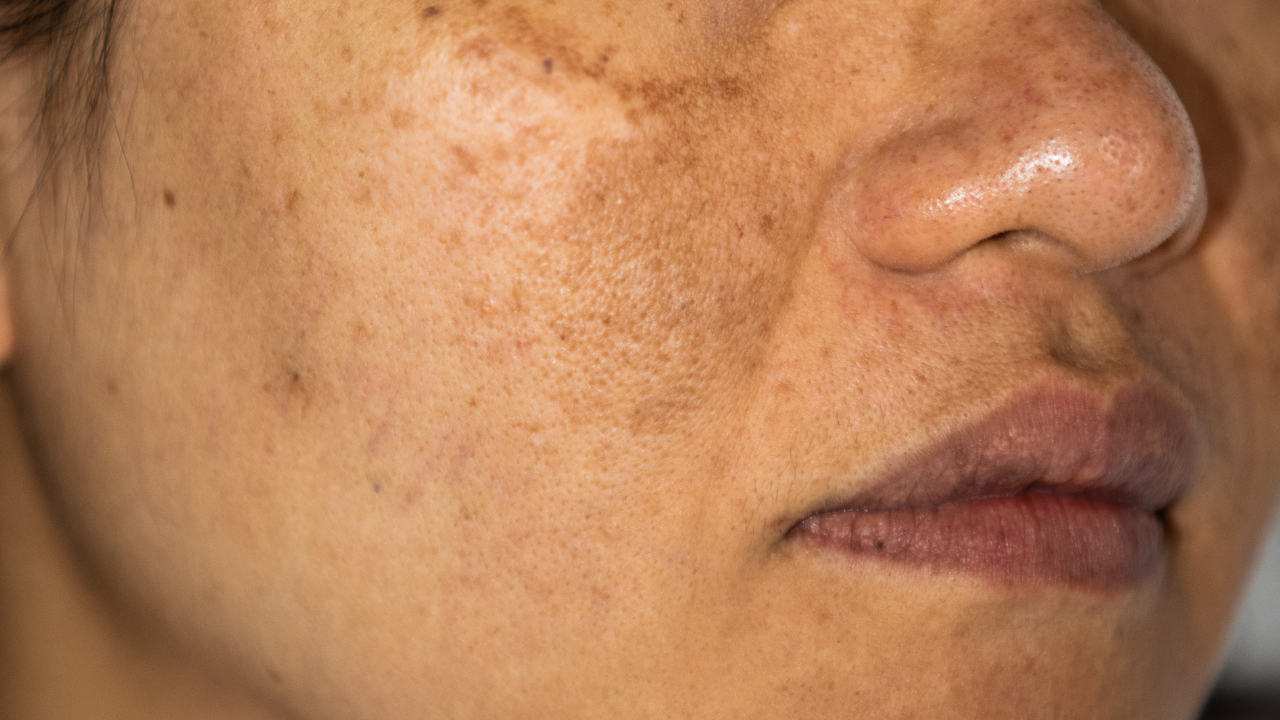 Donkere pigmentvlek op de wang na acne als voorbeeld van postinflammatoire hyperpigmentatie