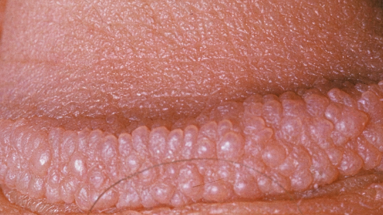 Parelketting (pearly penile papules) op de kroonrand van de penis: regelmatige krans van kleine huidkleurige bultjes