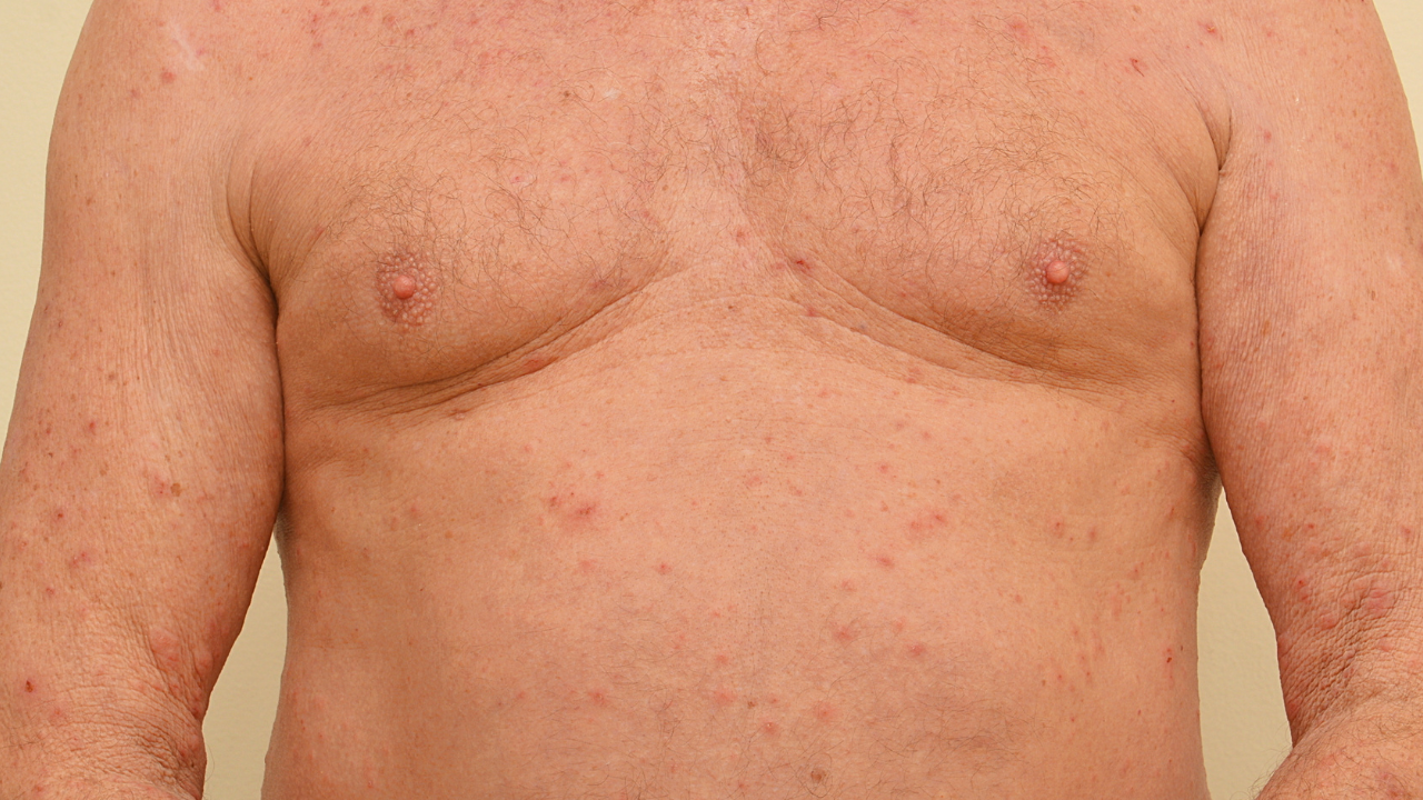 Schurftgangetjes tussen de vingers: kenmerkend beeld van scabies-infectie