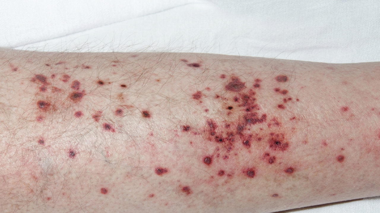 Purpura op de onderbenen bij vasculitis van de huid