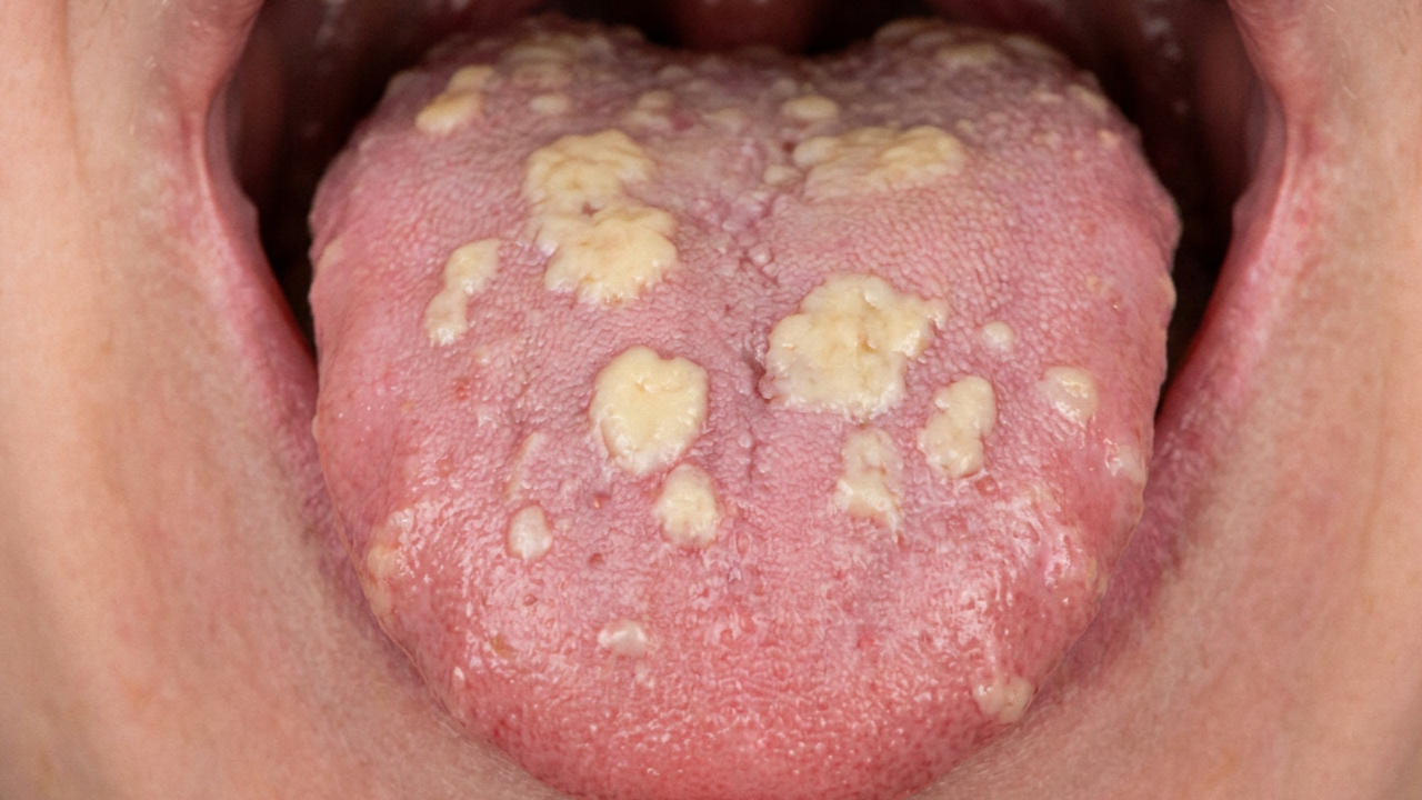 Witte plekjes op de tong van een baby door spruw (orale candidiasis