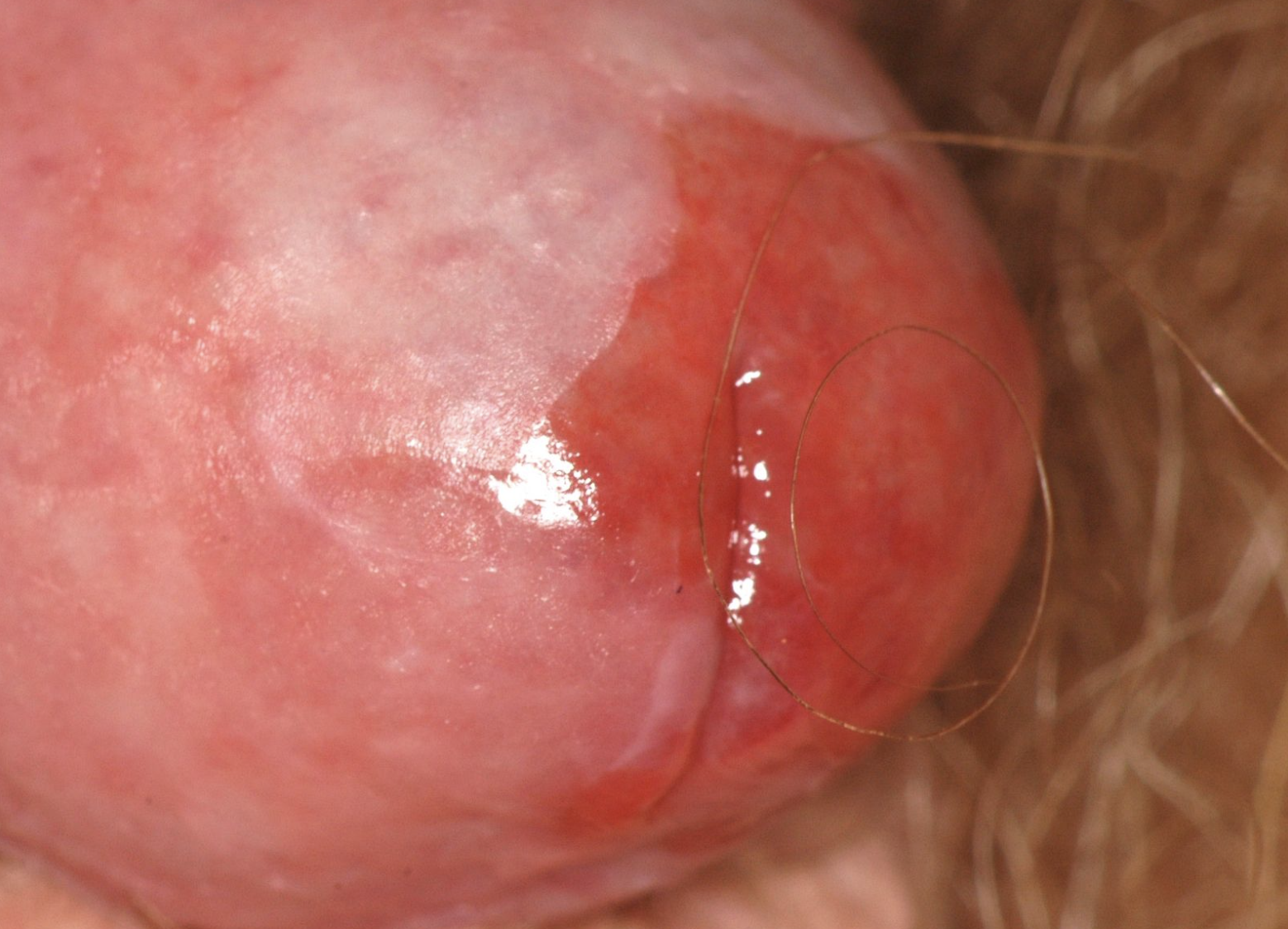 Balanitis skindr