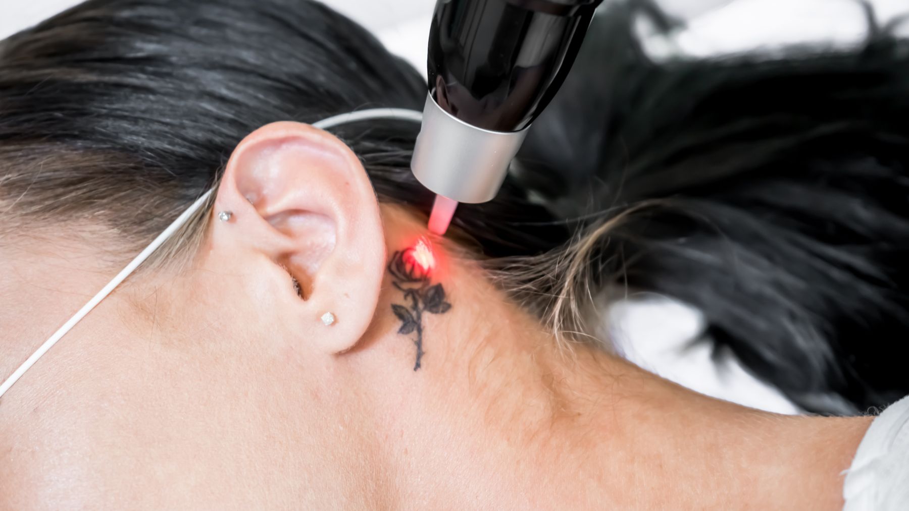 Laser usuwa mały tatuaż róży za uchem – laser pikosekundowy czy Q-Switch, Instytut DrStawowska Białystok