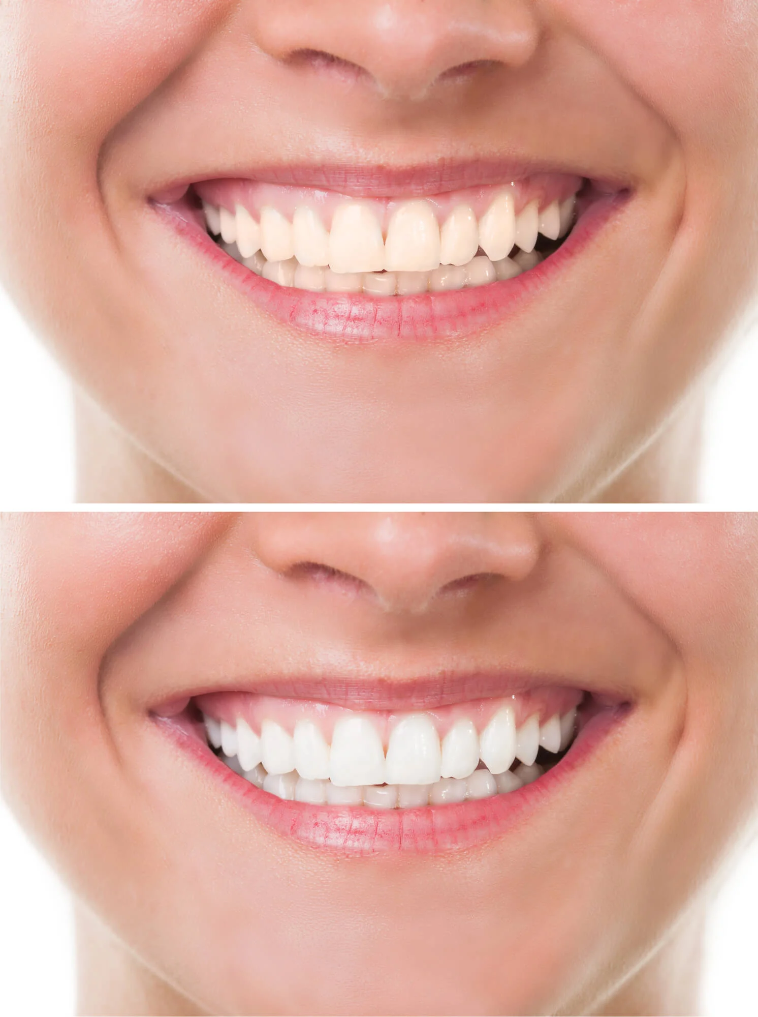brighter smile teeth whitening in Denver