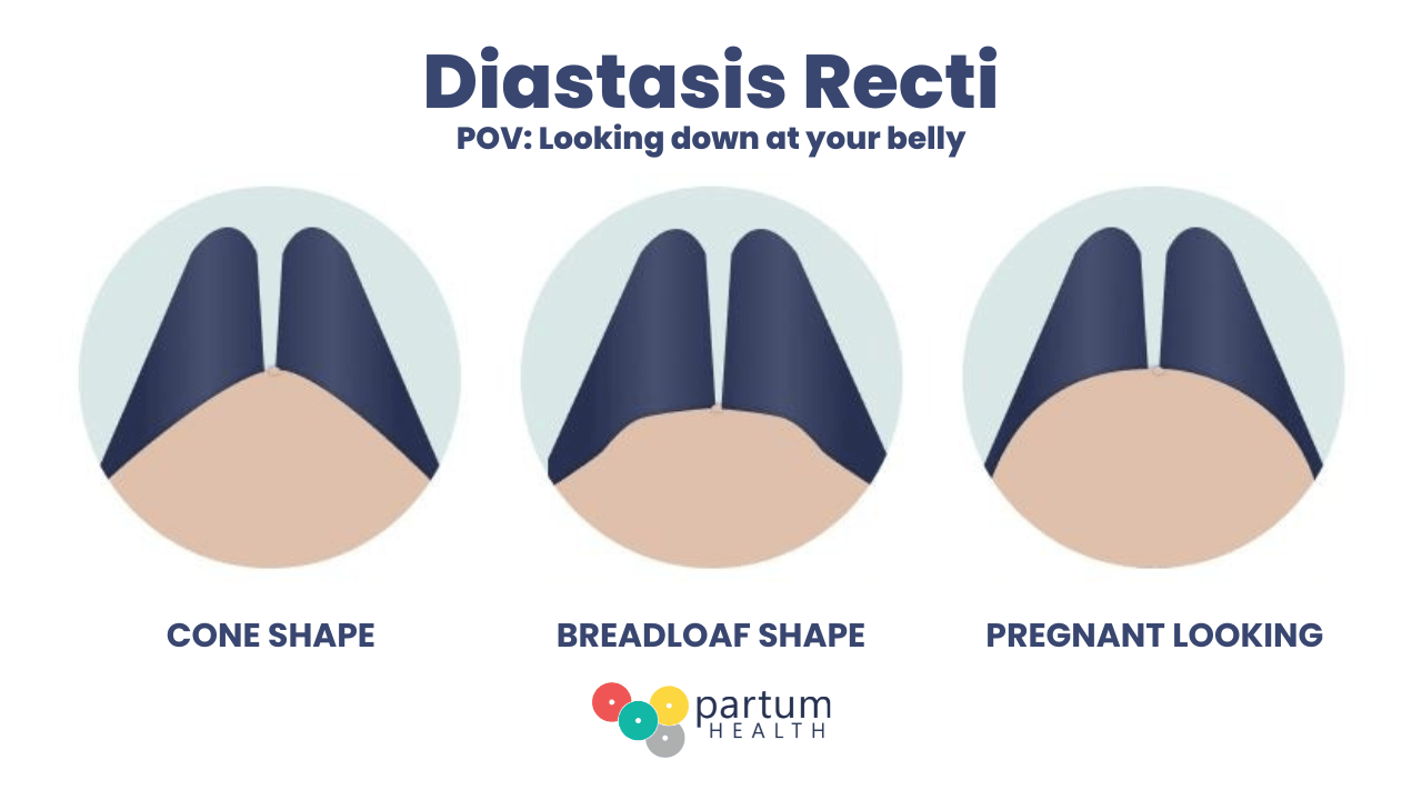 Three diagrams of Diastasis Recti, showing how a cone shape, breadloaf shape and “pregnant looking” might appear from the perspective of looking down at one’s belly