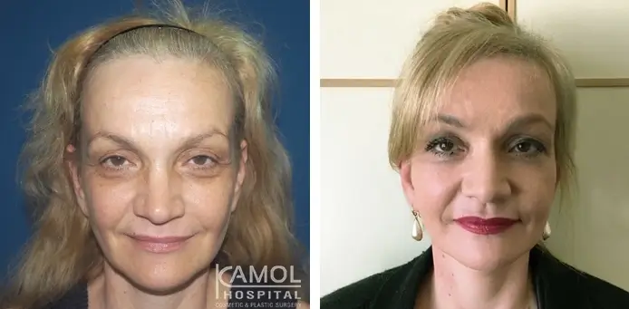 Kamol Hospital: before-after facelift 1