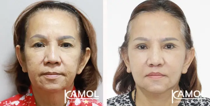 Kamol Hospital: before-after facelift 2