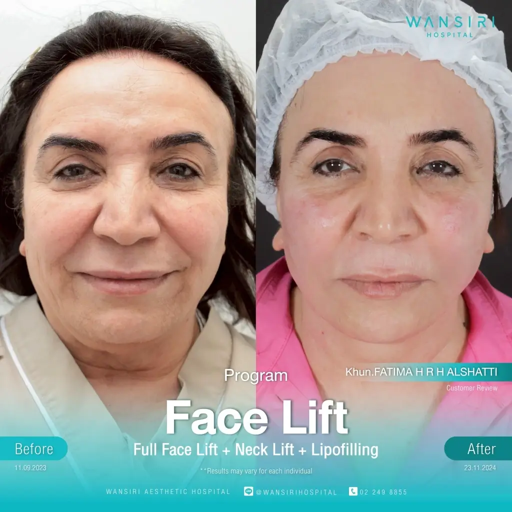 Before-after 3 (Wansiri Hospital)