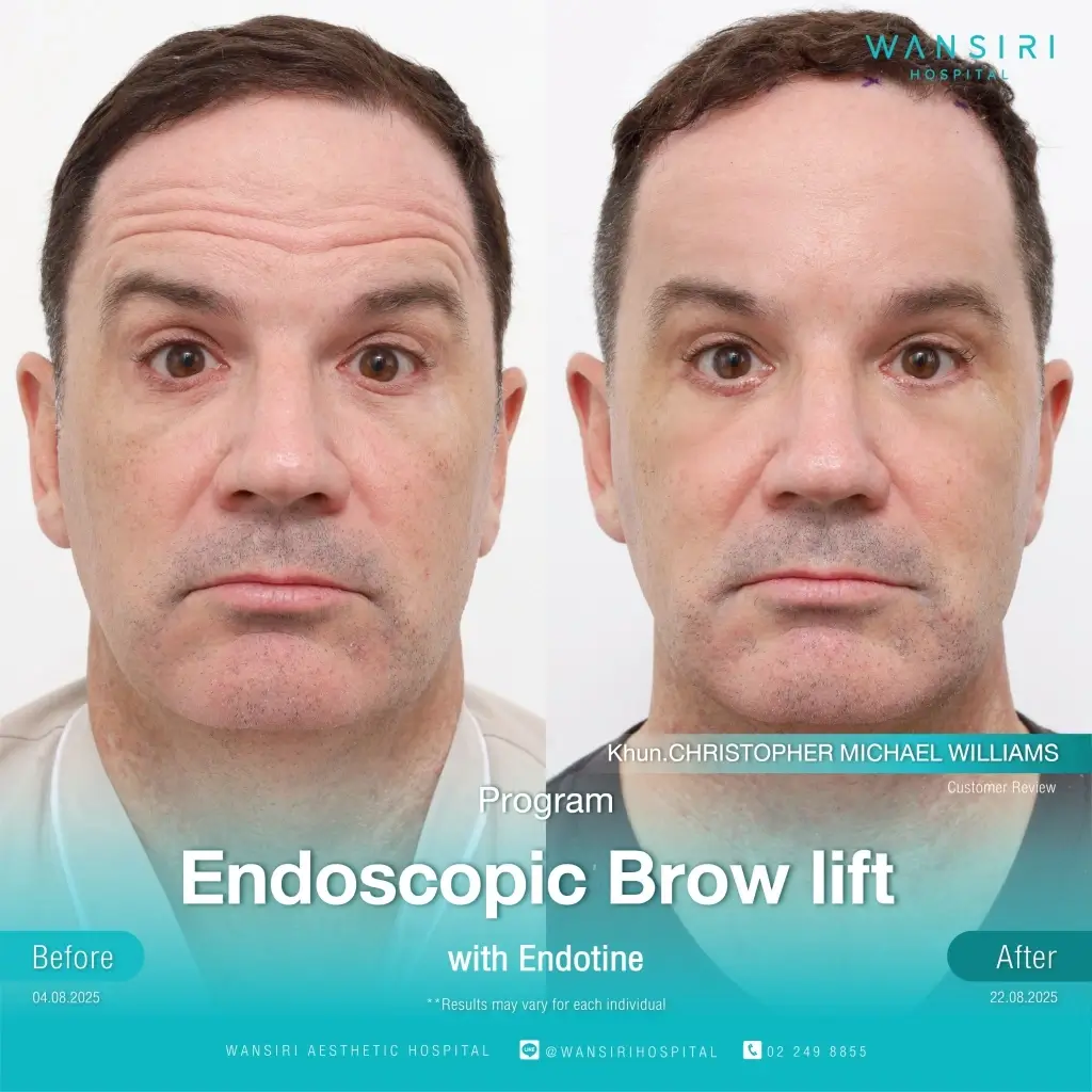 Before-after 1 (Wansiri Hospital)