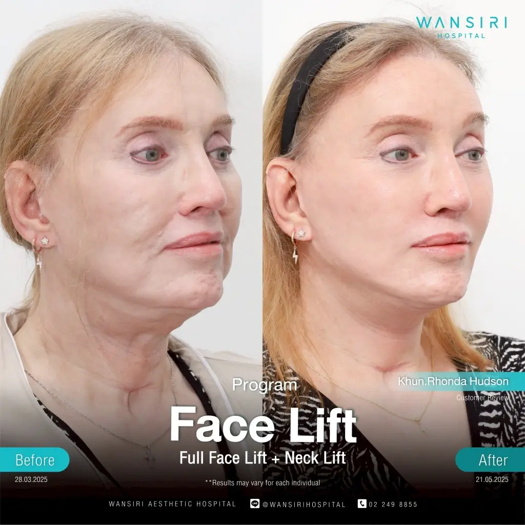 Before-after 4 (Wansiri Hospital)