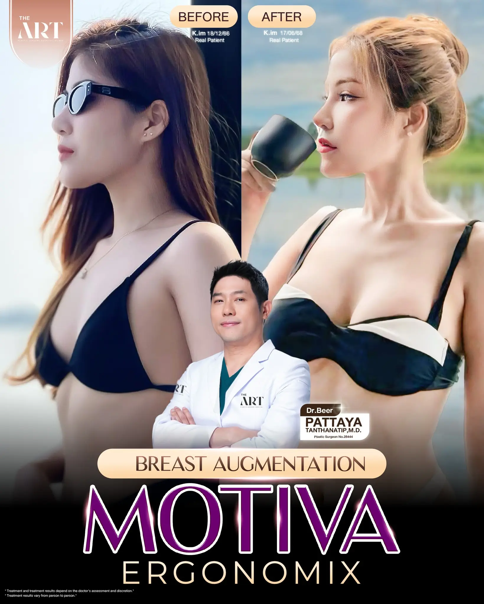 The Art Plastic Surgery Hospital Breast implants before-after