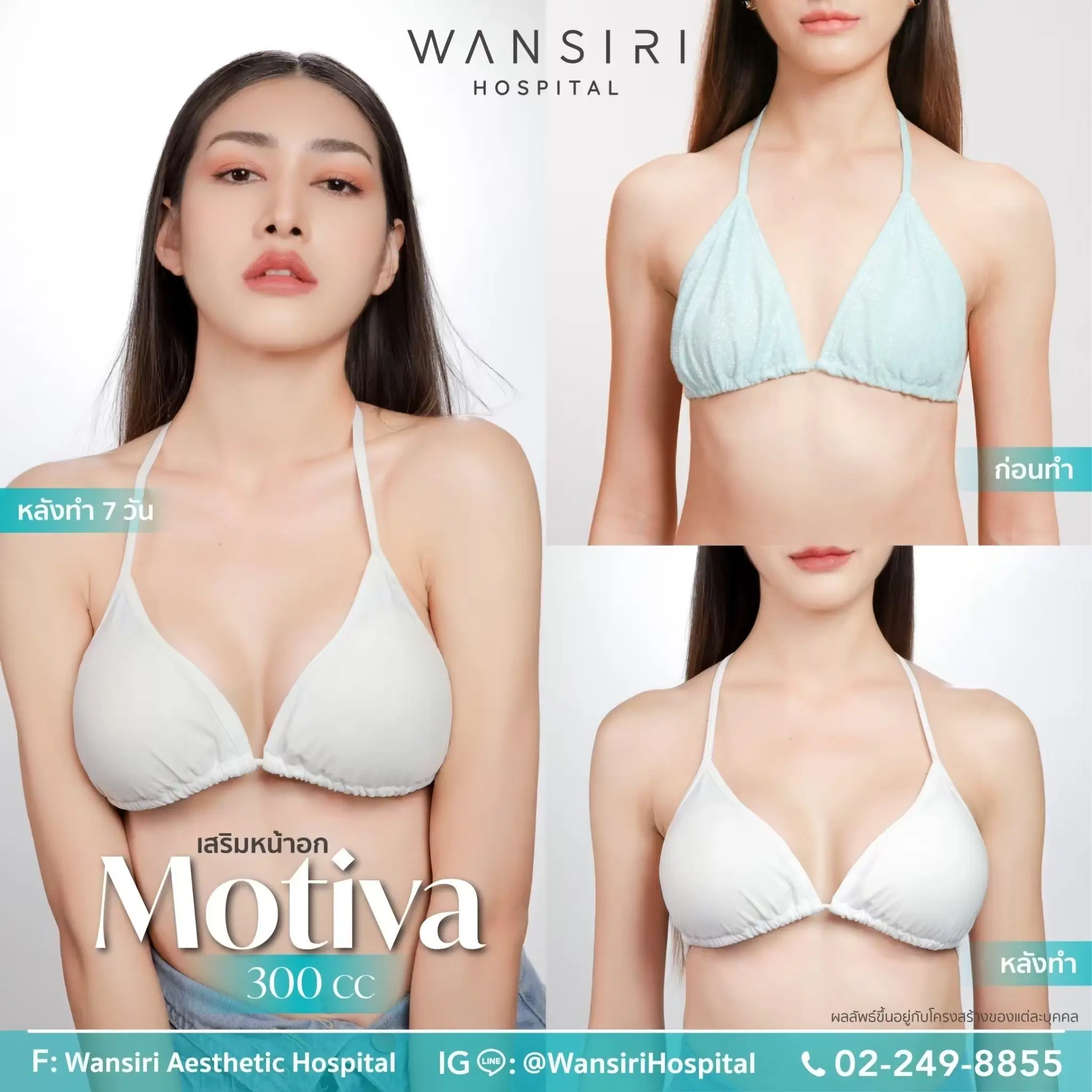 Wansiri Hospital Breast augmentation before-after