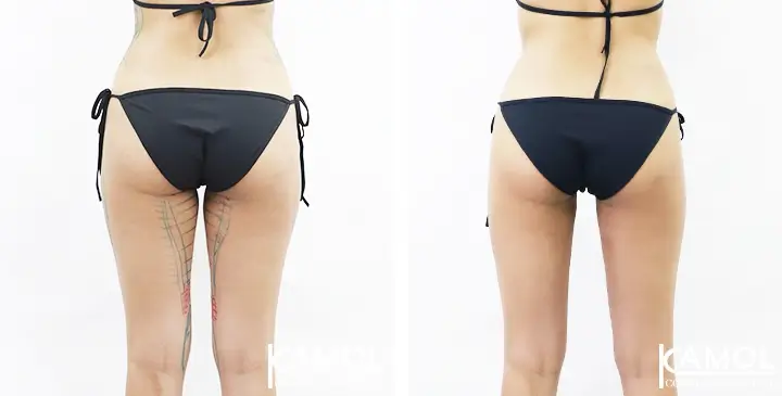 Kamol Cosmetic Hospital liposuction before-after