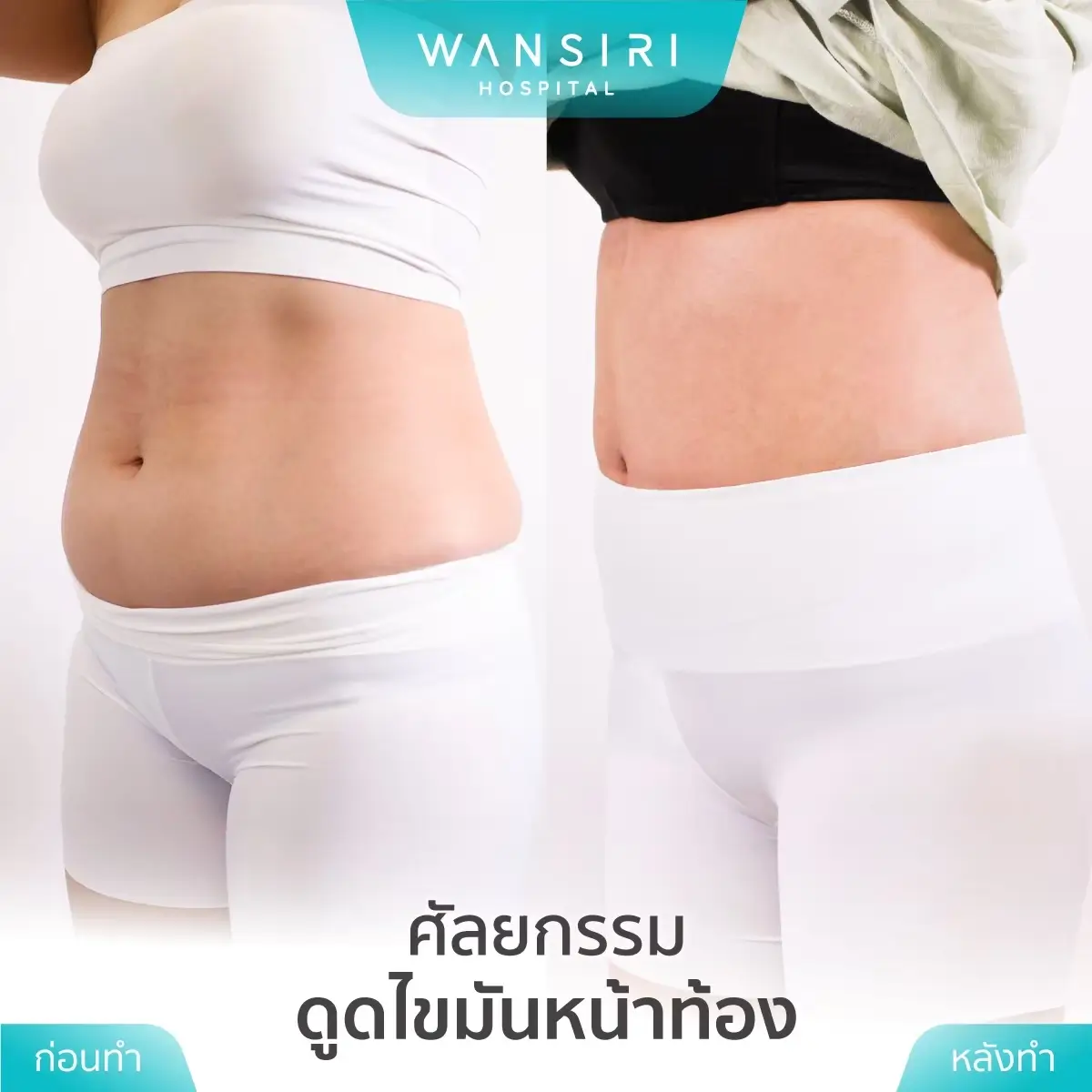 Wansiri Hospital liposuction before-after