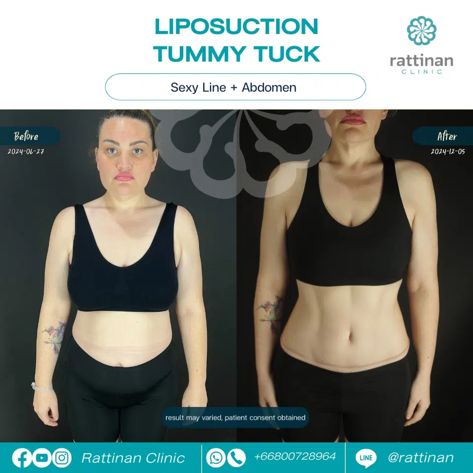 Rattinan Medical Center tummy tuck before-after