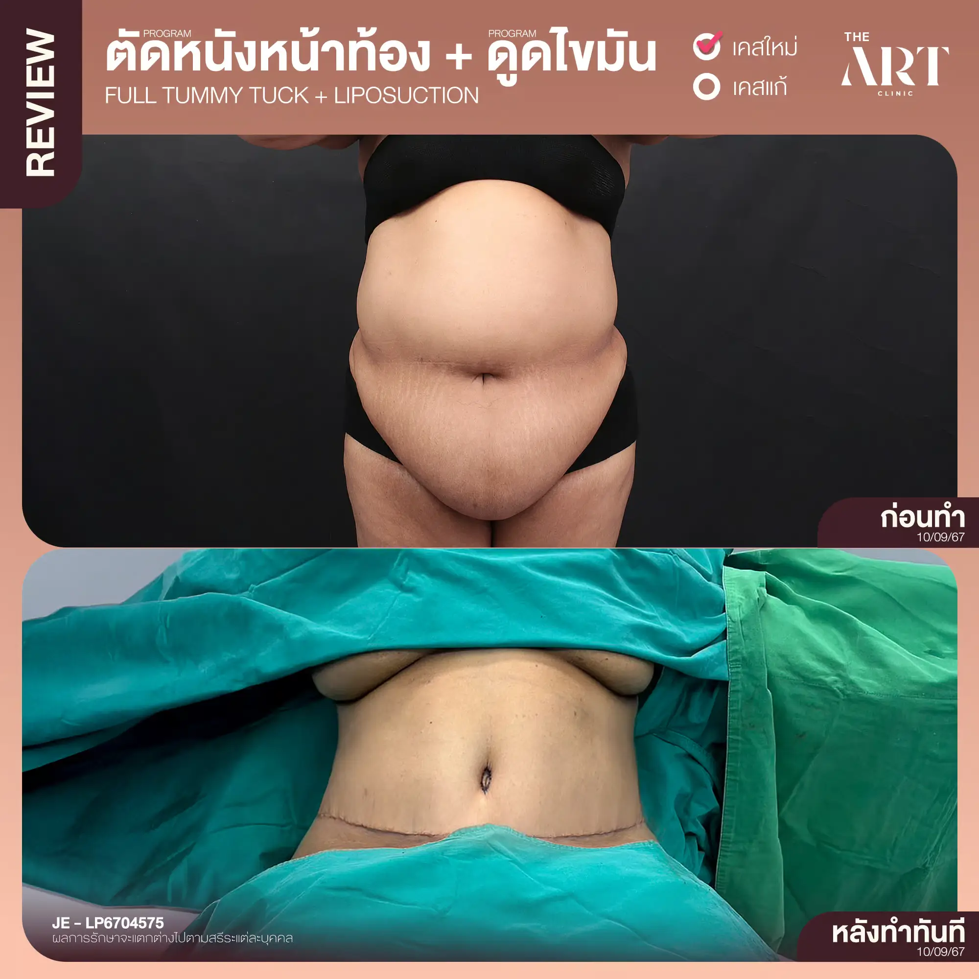 The Art Plastic Surgery Hospital tummy tuck before-after