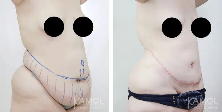 Kamol Cosmetic Hospital tummy tuck before-after
