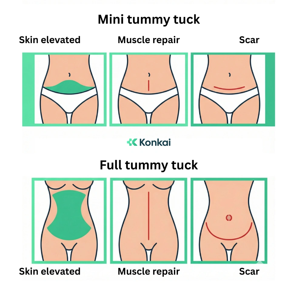 Types of Tummy Tuck Procedures