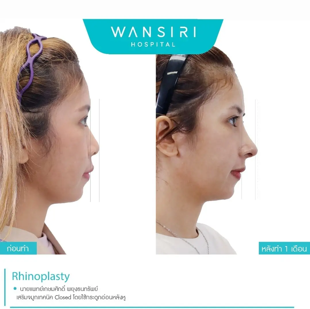 Wansiri Hospital rhinoplasty before-after