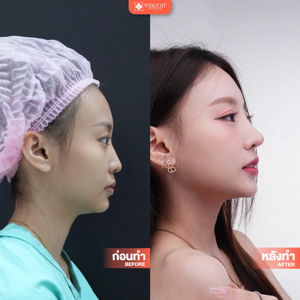 Vincent Clinic Rhinoplasty before-after