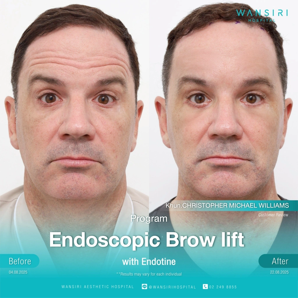 Wansiri Hospital facelift before-after