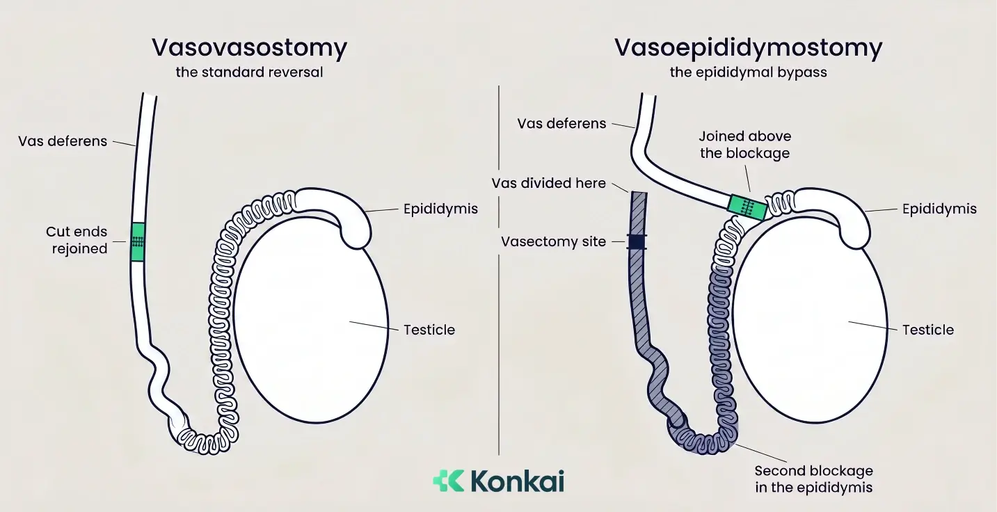 Vasovasostomy versus vasoepididymostomy