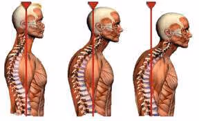forward head syndrome diagram