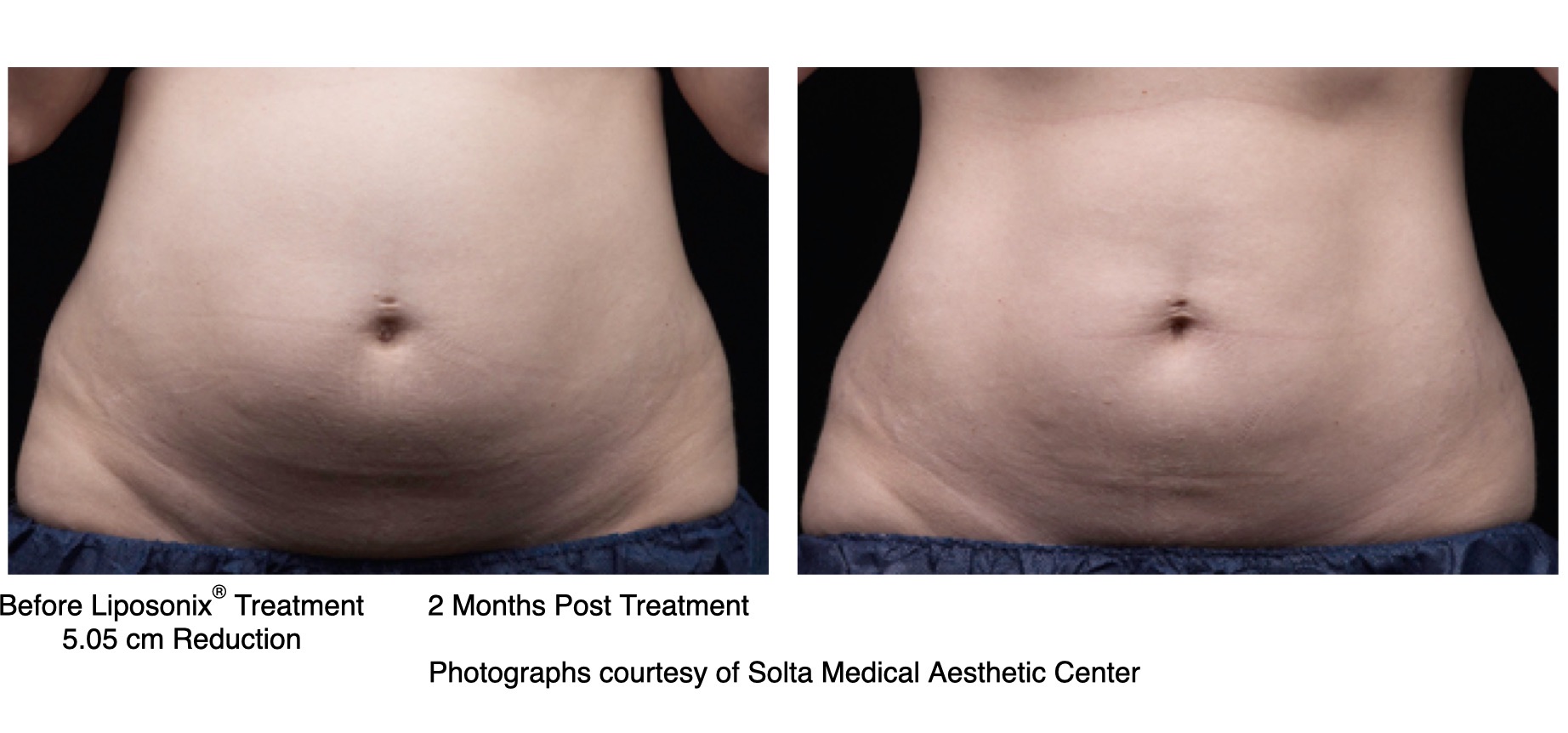 LipoSonix abdomen contouring before-and-after results