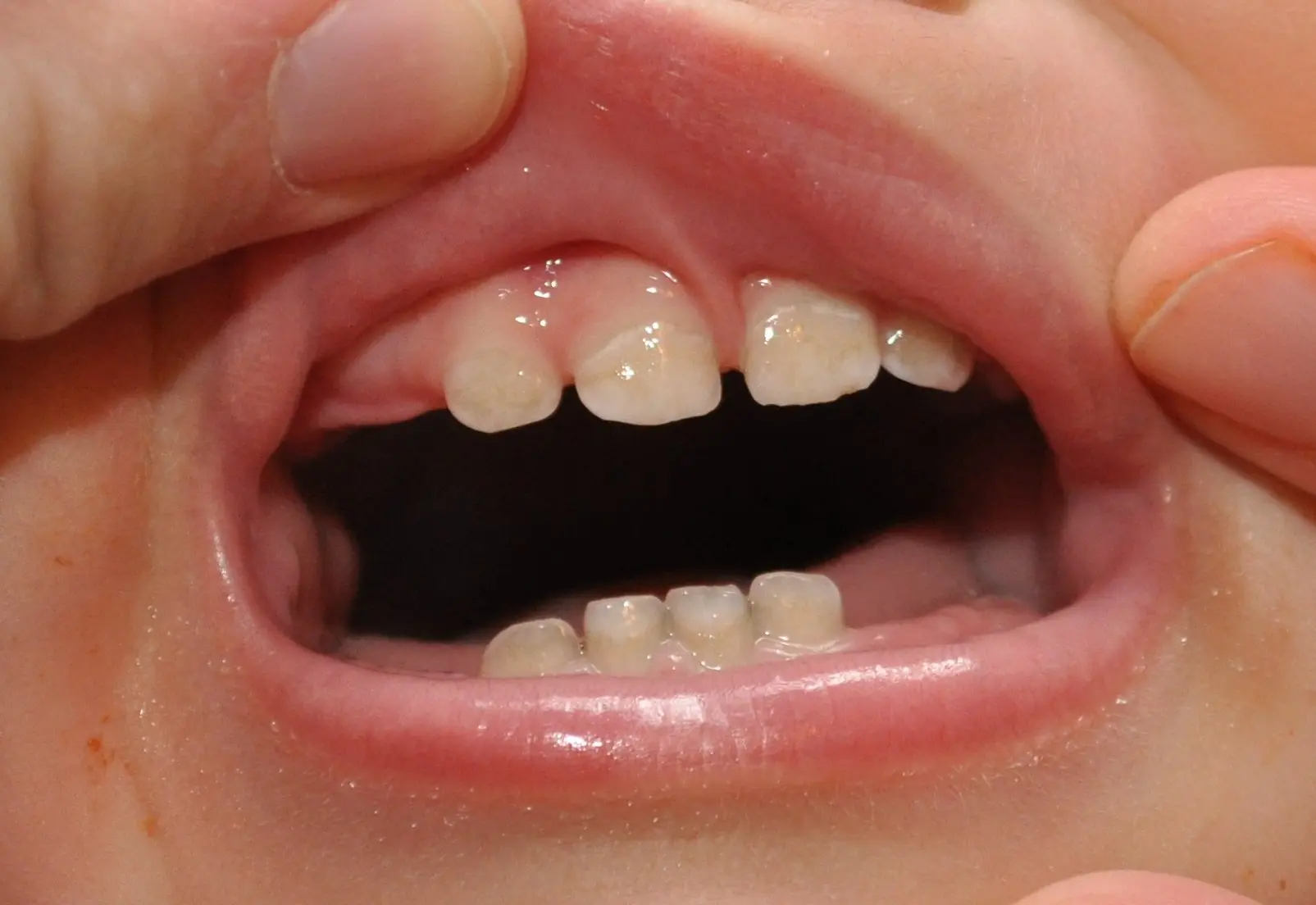 Tooth Extractions in Darien, CT