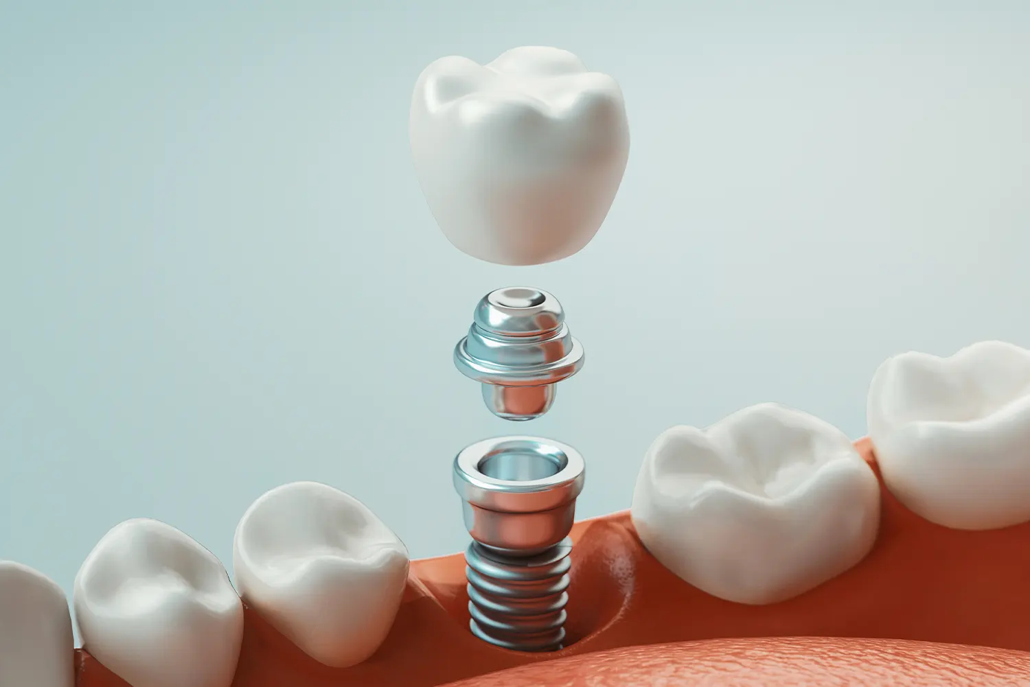 Single-tooth dental implants