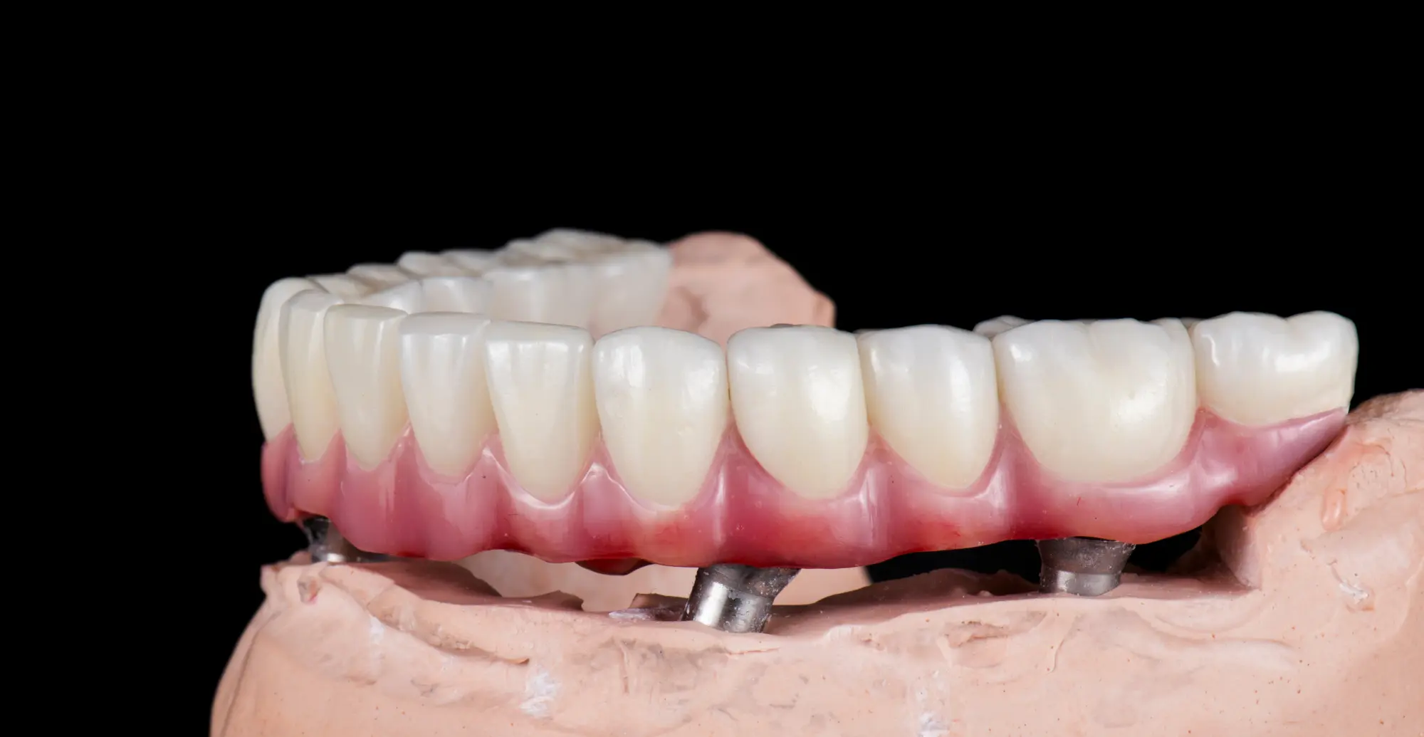 Implant-supported dentures