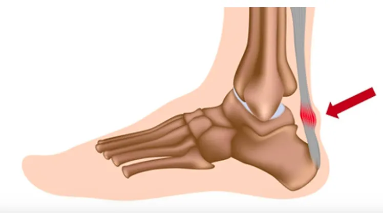 Foot and ankle bone illustration with a red arrow pointing to the inflamed Achilles tendon