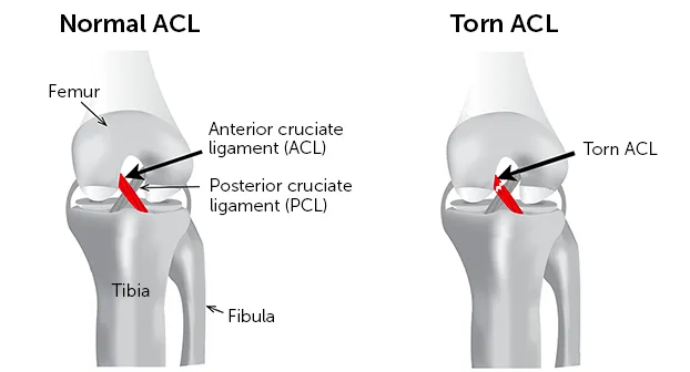 Diagram comparing a normal ACL with a torn ACL, labeling femur, tibia, fibula and PCL