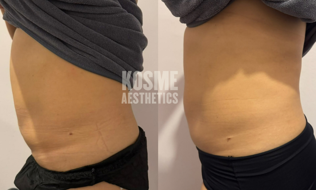 Fat Freeze before and after result 3