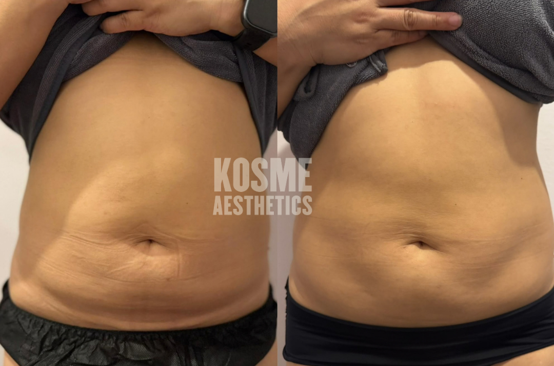 Fat Freeze before and after result 2