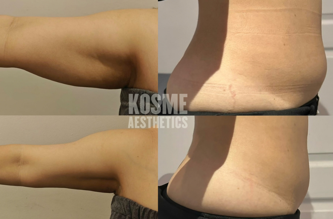 Fat Freeze before and after result 1