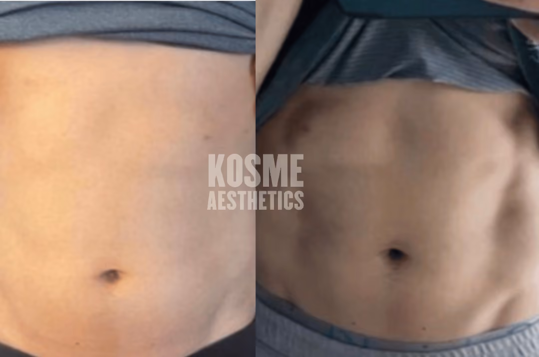 EmShape before and after result 1
