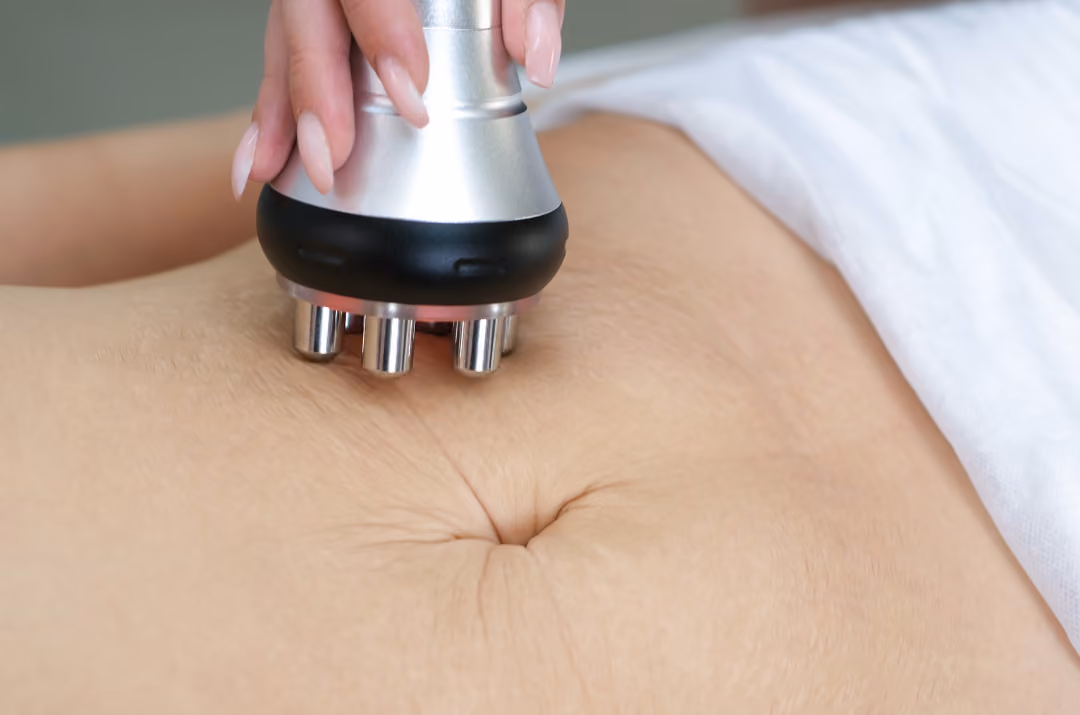 RF Slimming treatment at Kosme Aesthetics Singapore
