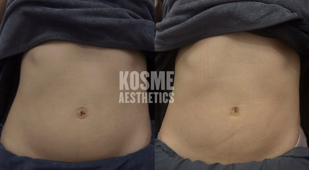 RF Slimming before and after result 1