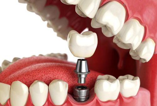 dental implants Indianapolis, IN 3d cutaway view showing on dental implant on the lower mouth arch