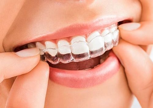 night guards: closeup of a woman putting on an upper mouth night guard