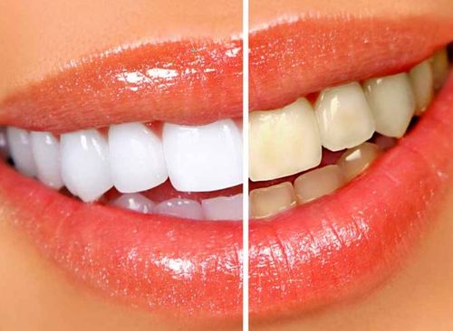 Teeth whitening demonstration picture after on the left and before on the right