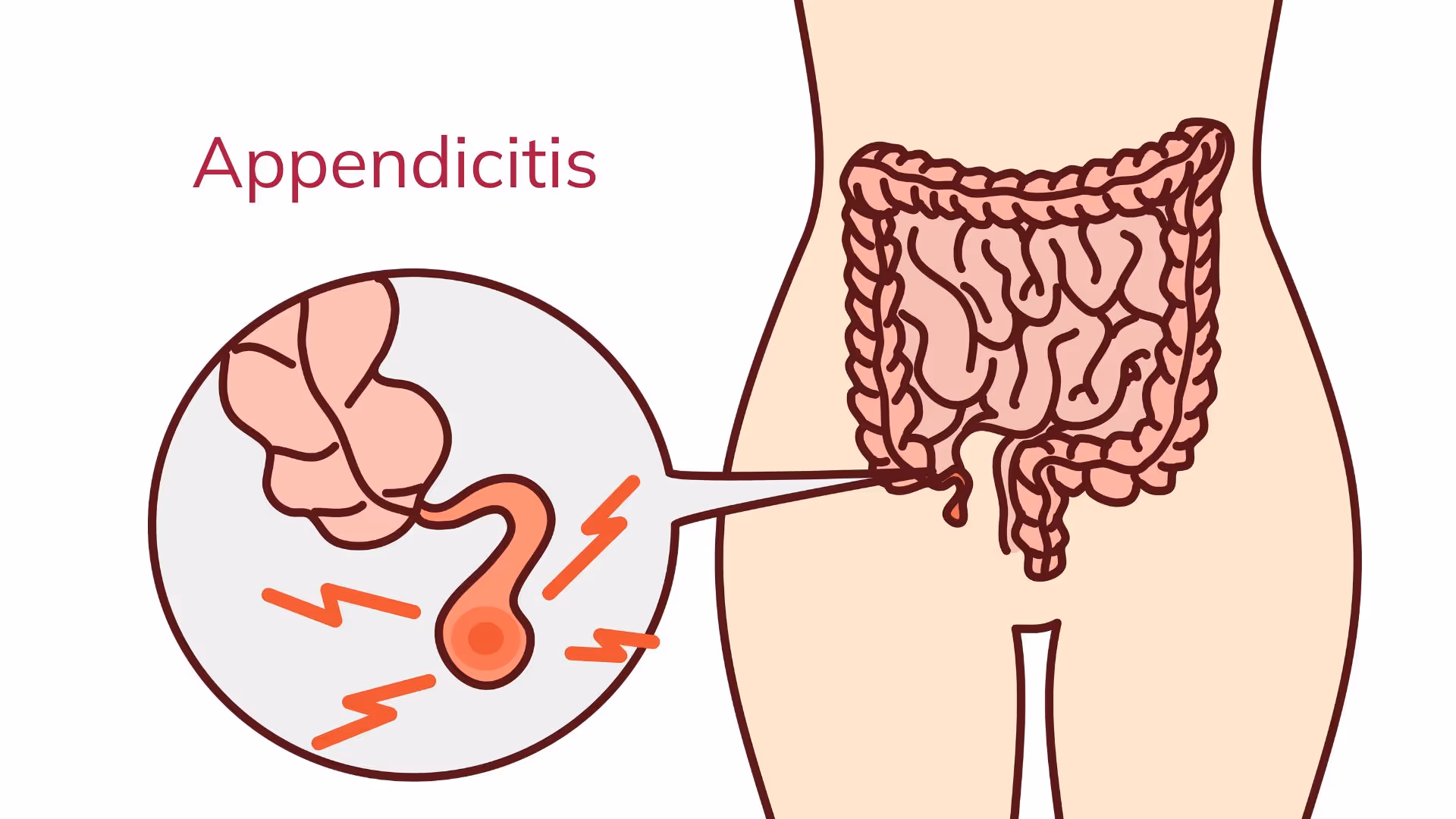 ما هو التهاب الزائدة الدودية ولماذا يُعد حالة طارئة؟