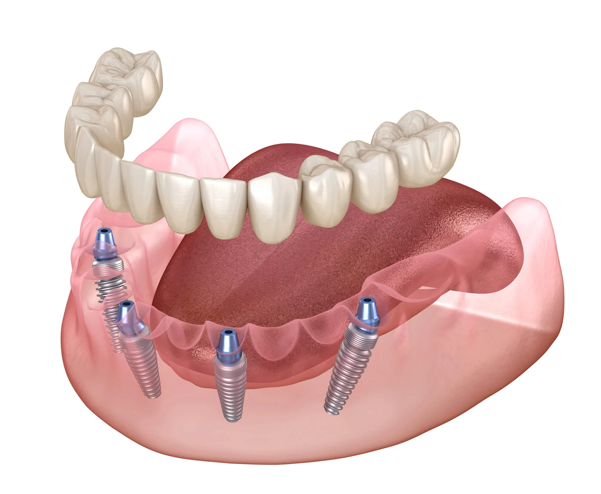 full arch dental implants in Bridgeport