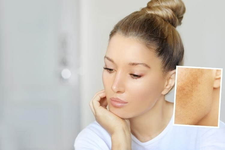 Nám, sạm da cũng có thể xuất hiện do yếu tố di truyền