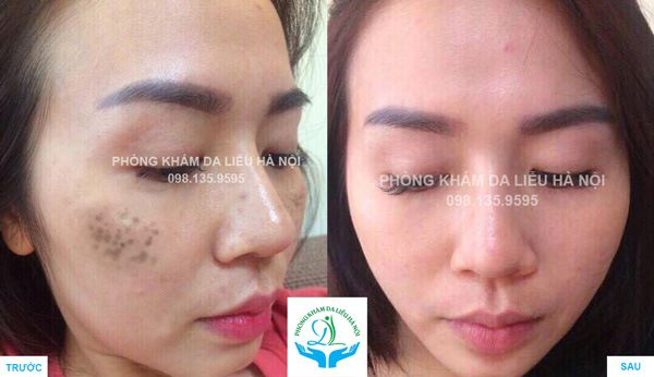 Phòng Khám Da liễu Hà Nội